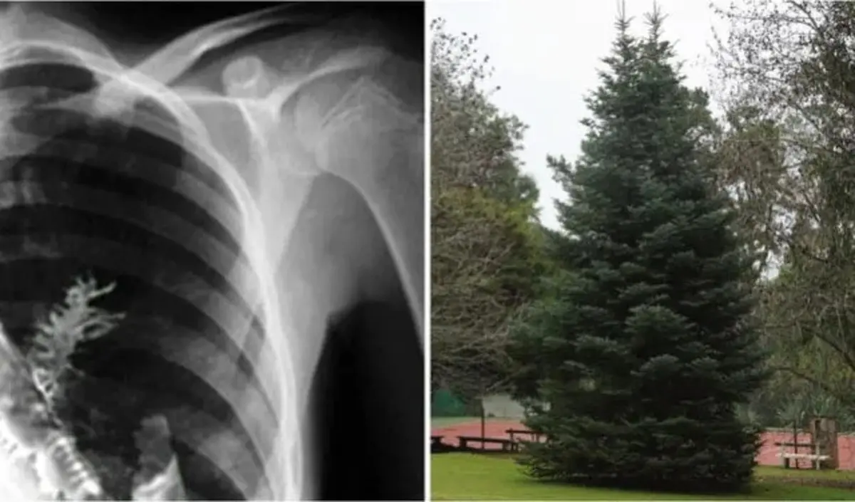 Un Árbol en Tus Pulmones: ¿Mito o Realidad? - Es posible que crezca un árbol en tus pulmones arbol en los pulmones - Es posible que crezca un árbol en tus pulmones