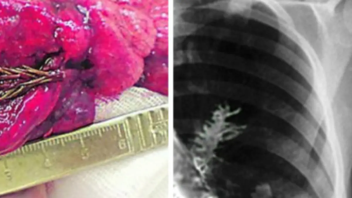 Un Árbol en Tus Pulmones: ¿Mito o Realidad? - Qué enfermedades salen en los pulmones arbol en los pulmones - Qué enfermedades salen en los pulmones